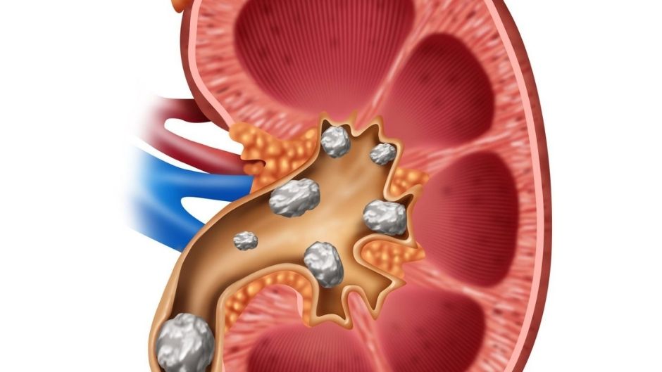 The Impact of Diet on Kidney Stones Formation